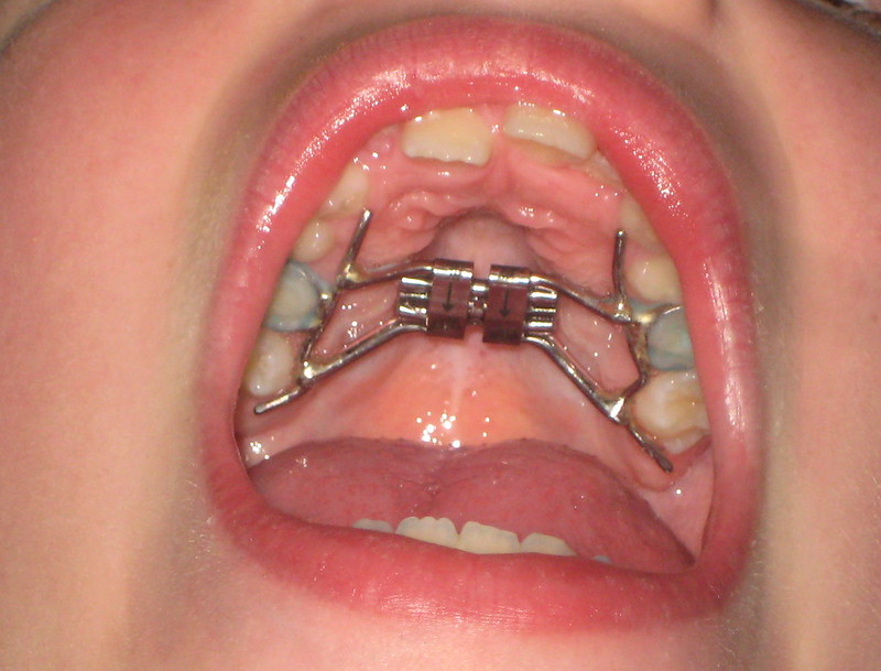 22最全澳洲牙齿矫正攻略 整牙价格 牙套推荐 整牙保险 悉尼 墨尔本牙齿矫正 Extrabux