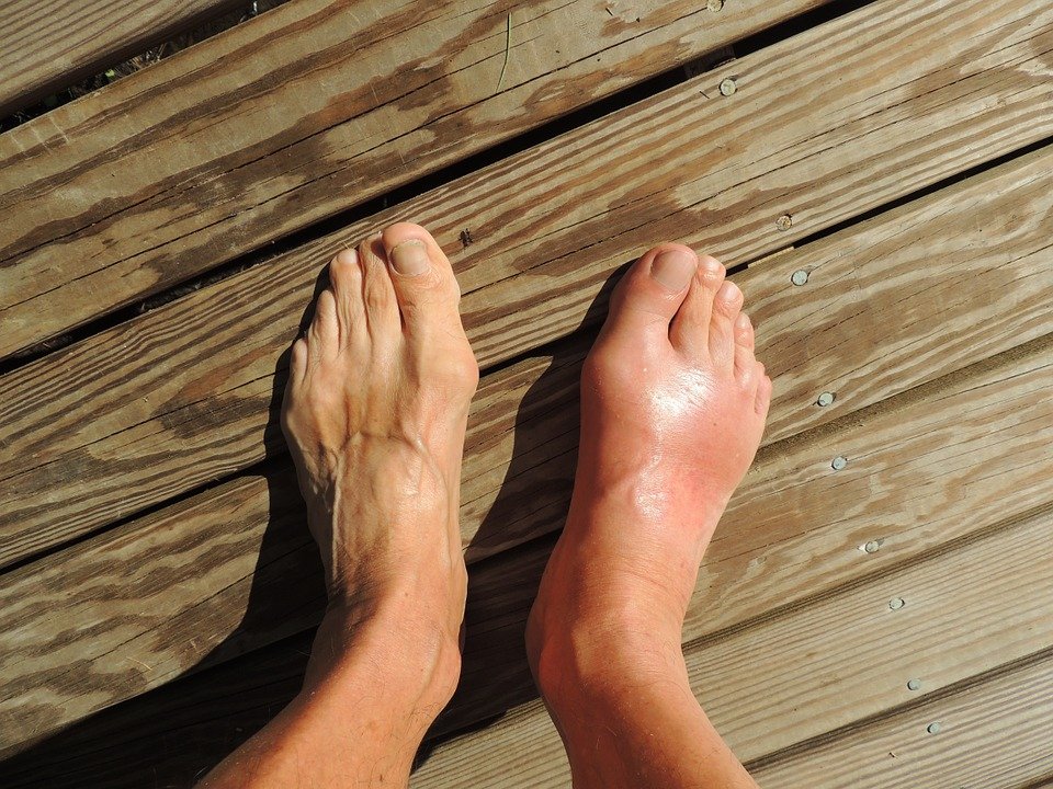 Feet, Gout, Pain, Foot, Human, Anomaly, Barefoot