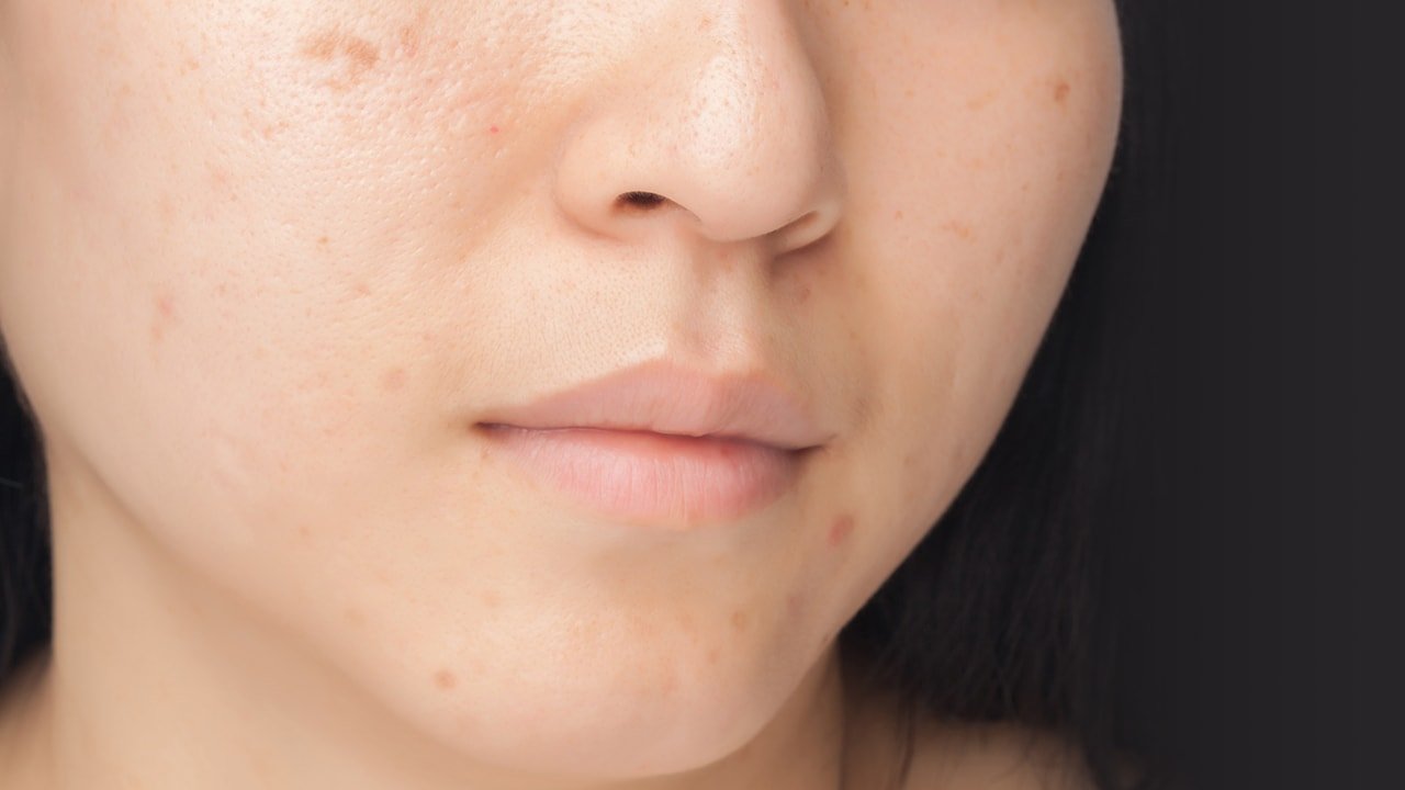 7 Best Ingredients to Treat Hyperpigmentation That Really Work
